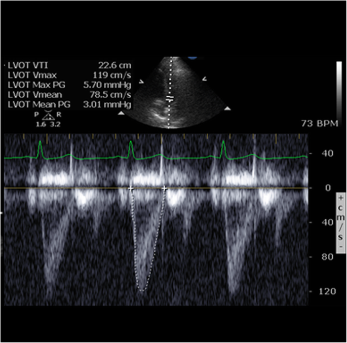 A novel method of calculating stroke volume using point-of-care  echocardiography | Cardiovascular Ultrasound | Full Text