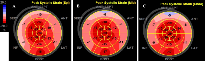 Layer‐specific strain echocardiography may reflect regional myocardial  impairment in patients with hypertrophic cardiomyopathy, Cardiovascular  Ultrasound