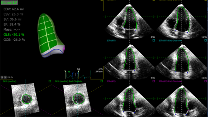 A review of current trends in three-dimensional analysis of left  ventricular myocardial strain, Cardiovascular Ultrasound