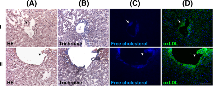 Accumulation of free cholesterol and oxidized low-density lipoprotein is  associated with portal inflammation and fibrosis in nonalcoholic fatty  liver disease | Journal of Inflammation | Full Text