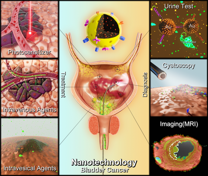 Application of nanotechnology in the diagnosis and treatment of bladder  cancer | Journal of Nanobiotechnology | Full Text