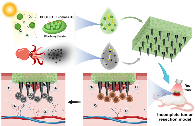 Living photosynthetic microneedle patches for in situ oxygenation and postsurgical melanoma therapy | Journal of Nanobiotechnology | Springer Nature Link