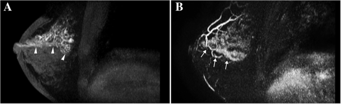 intraductal papilloma breast mri a condyloma következménye férfiaknál