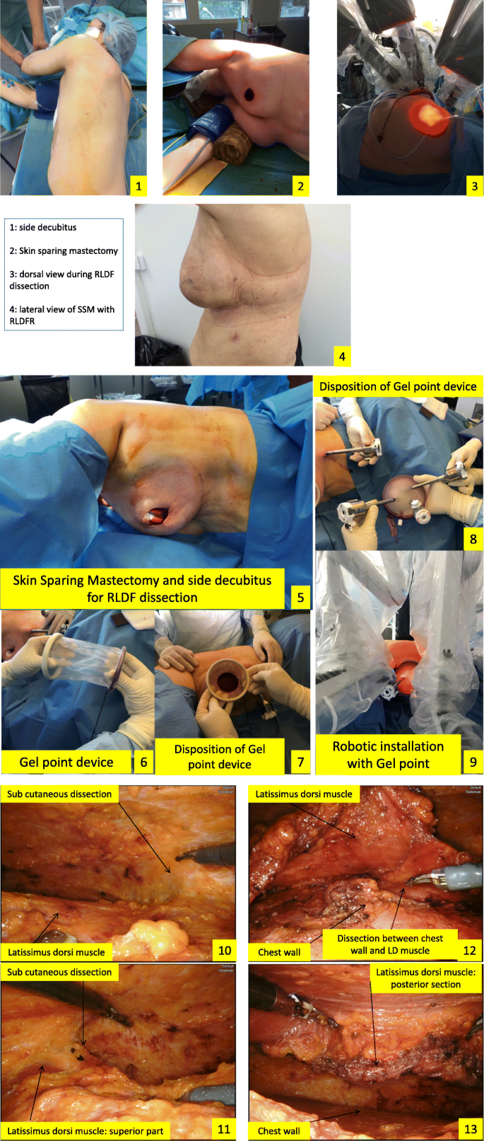 Skin sparing mastectomy and robotic latissimus dorsi-flap reconstruction  through a single incision | World Journal of Surgical Oncology | Full Text