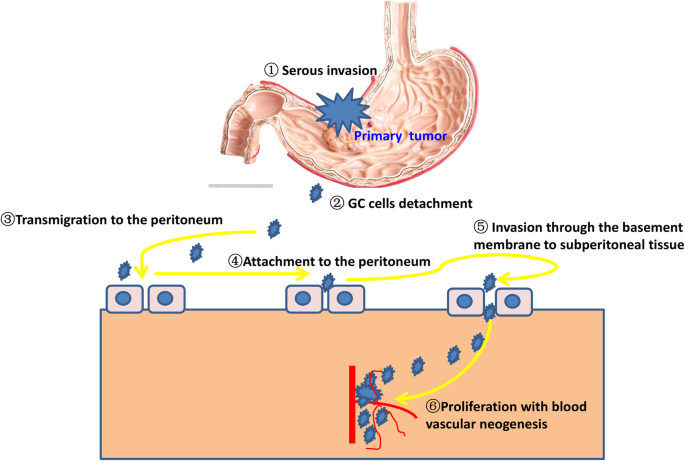 gastric cancer with ascites oxiuros que debo tomar