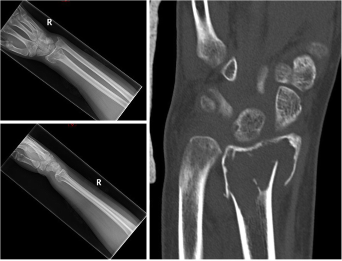 The use of denosumab in the setting of acute pathological fracture through  giant cell tumour of bone | World Journal of Surgical Oncology | Full Text