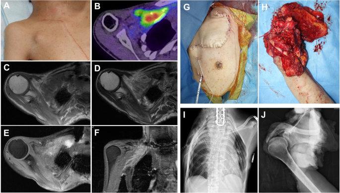 metastatic melanotic peripheral nerve sheath sarcoma causes A para-aortic malignant melanotic nerve sheath tumor mimicking a  gastrointestinal stromal tumor: a rare case report and review of literature  | BMC Surgery main image 1