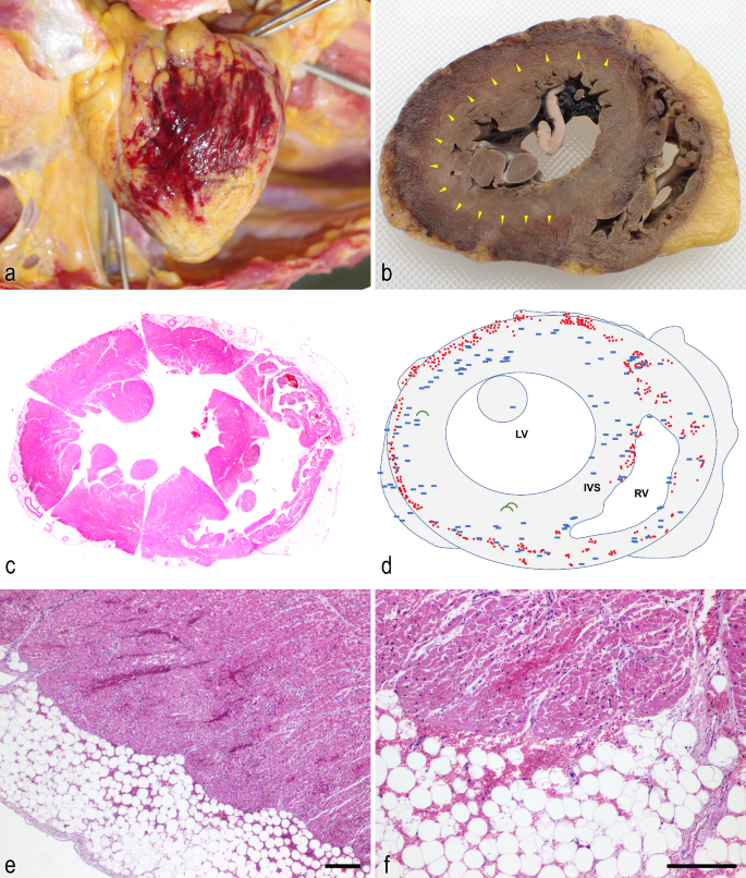 Staph's activation of blood clotting, VUMC Reporter