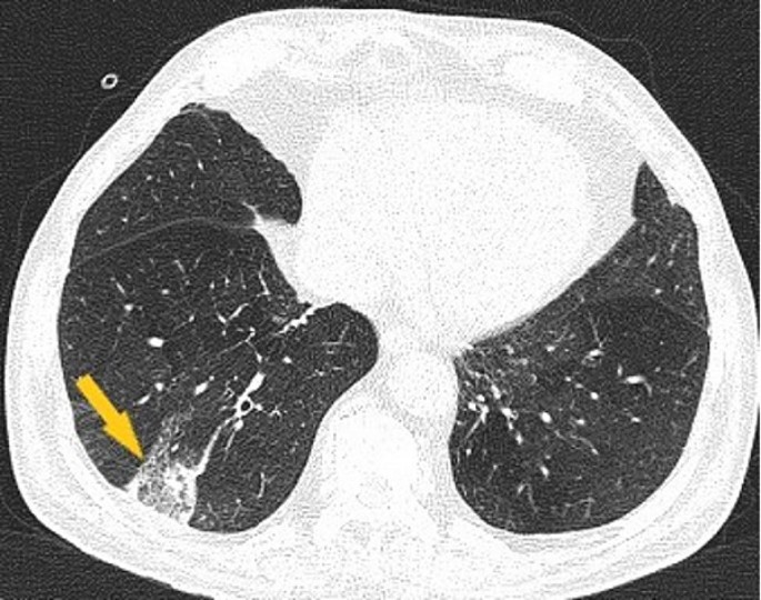Unprovoked venous thromboembolism recurrence and arterial embolism 
