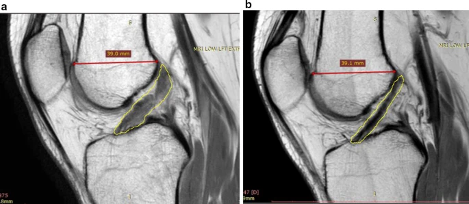 MRIs with ACL outlined showing progression of ACL healing after Cellular Therapy and Stem Cells for Musculoskeletal Diseases and Orthopedic Conditions. a Pre-treatment MRI showing injured ACL. b MRI at 6-8 months post-treatment displaying characteristics typical of an less injured and improved ACL (darker, more dense) indicating healing, with corresponding improvements in stability and function measured by Lachman and pivot shift tests