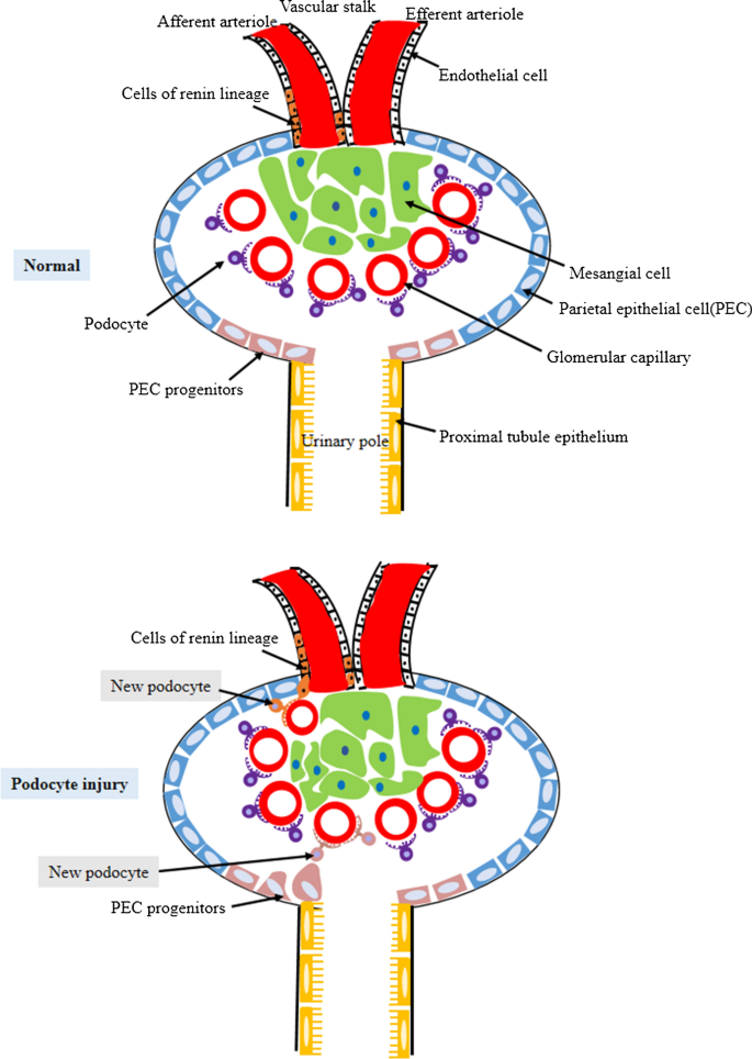 Sea anemone sick Imperative The recruitment mechanisms and potential therapeutic targets of podocytes  from parietal epithelial cells | Journal of Translational Medicine | Full  Text