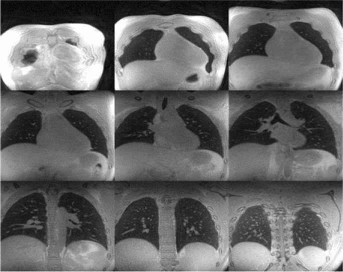 Radiology of fibrosis. Part I: Thoracic organs | Journal of 