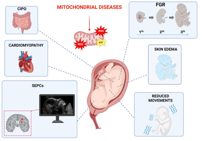 Fetal and obstetrics manifestations of mitochondrial diseases 