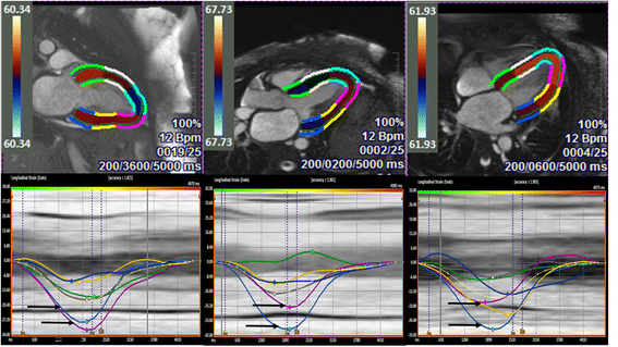 Relative Apical Sparing of Myocardial Longitudinal Strain Is Explained by  Regional Differences in Total Amyloid Mass Rather Than the Proportion of  Amyloid Deposits