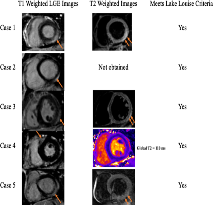 Electrocardiogram and Echocardiographic Findings of COVID-19 Patients in  Makati Medical Center – ASEAN Heart Journal