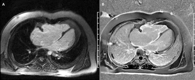 Society for Cardiovascular Magnetic Resonance 2020 Case of the Week series  | Journal of Cardiovascular Magnetic Resonance | Full Text