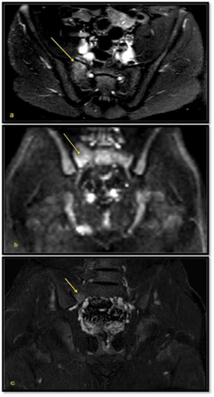 Usefulness of magnetic resonance enterography in detecting signs of  sacroiliitis in young patients with inflammatory bowel disease | Pediatric  Rheumatology | Full Text