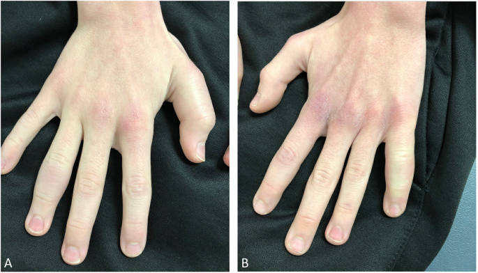 Vitamin C deficiency mimicking inflammatory bone disease of the hand |  Pediatric Rheumatology | Full Text