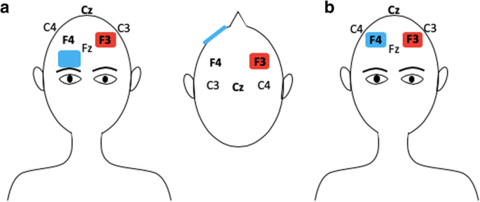 dorsolateral prefrontal cortex tdcs