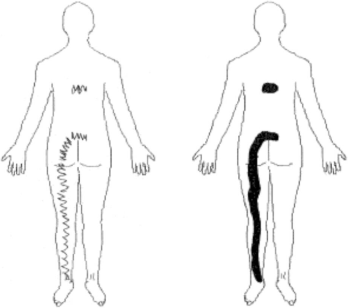 Where do patients with MRI-confirmed single-level radiculopathy experience pain, and what is the clinical interpretability of these pain patterns? A cross-sectional diagnostic accuracy study | Chiropractic & Manual Therapies | Full Text