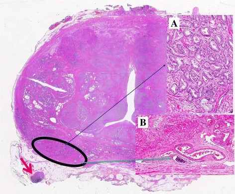 adenocarcinom prostatic acinar scor gleason 6(33)