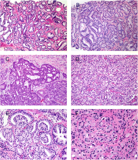 Fișier:Prostate cancer with Gleason pattern 4 low masinideepocanunti.ro - Wikipedia