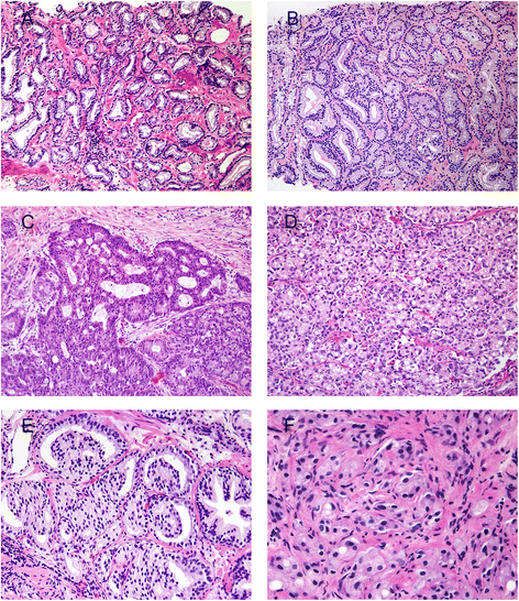 Mi mit jelent a prosztatarák patológiai leletén?, Adenocarcinoma prostate grade 4