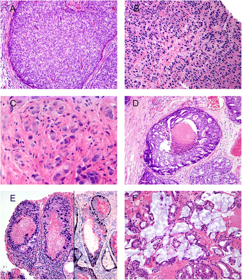 johns hopkins prostate cancer grading)