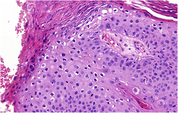 pikkelyes papilloma nyelőcső p16