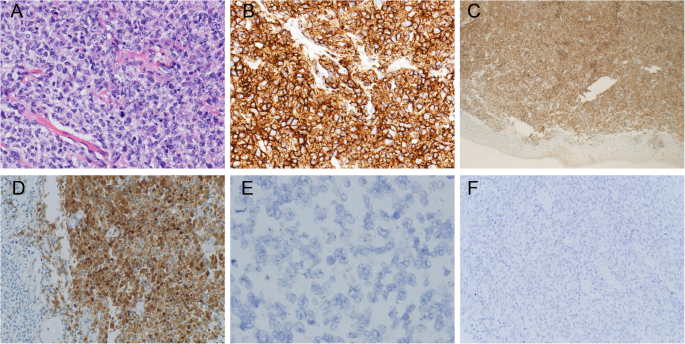 hpv vírus és lymphoma