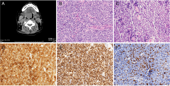 hpv vírus és lymphoma