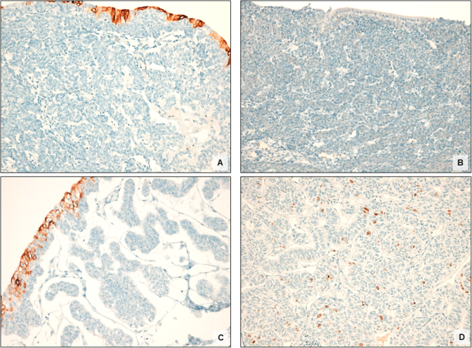 inverted papilloma bladder immunohistochemistry hpv causes and treatment