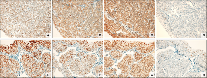 Inverted papilloma bladder immunohistochemistry - Papillomavirus g