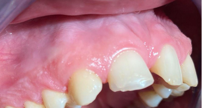Oral mucosal changes caused by nicotine pouches: case series | Diagnostic  Pathology