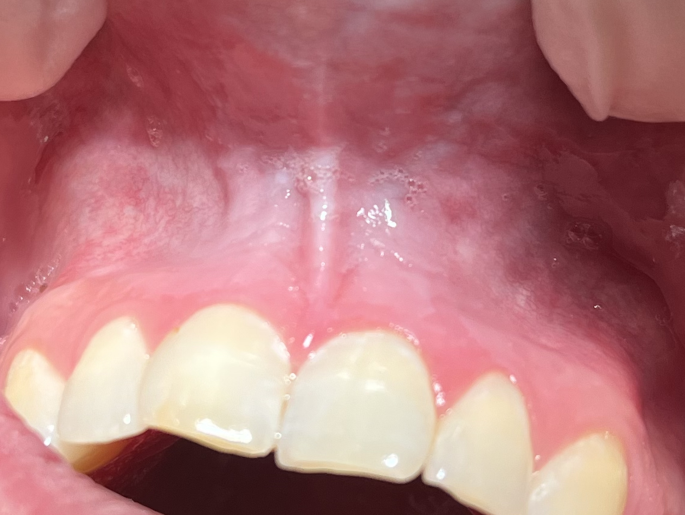 chewing tobacco lip sores Oral mucosal changes caused by nicotine pouches: case series | Diagnostic  Pathology