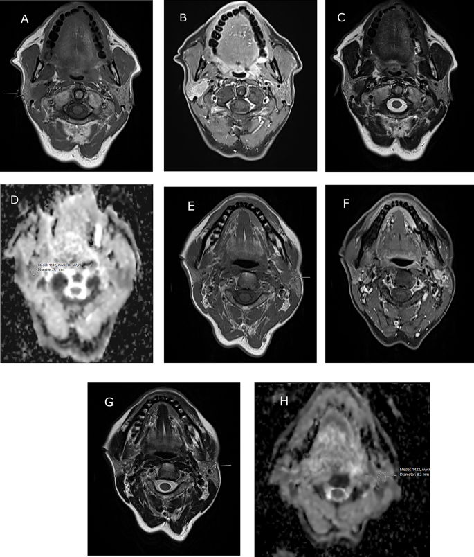 Bilateral synchronous salivary gland tumors: report of three cases ...