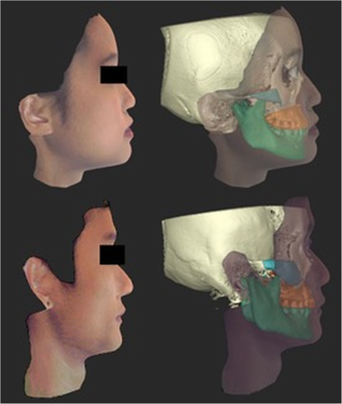 Evaluation of the relationship between malar projection and lower facial  convexity in terms of perceived attractiveness in 3-dimensional  reconstructed images | Head & Face Medicine | Full Text