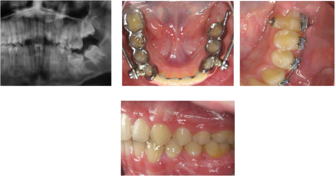 The Herbst Appliance And Its Modifications Prevalence And Individuality Head Face Medicine Full Text