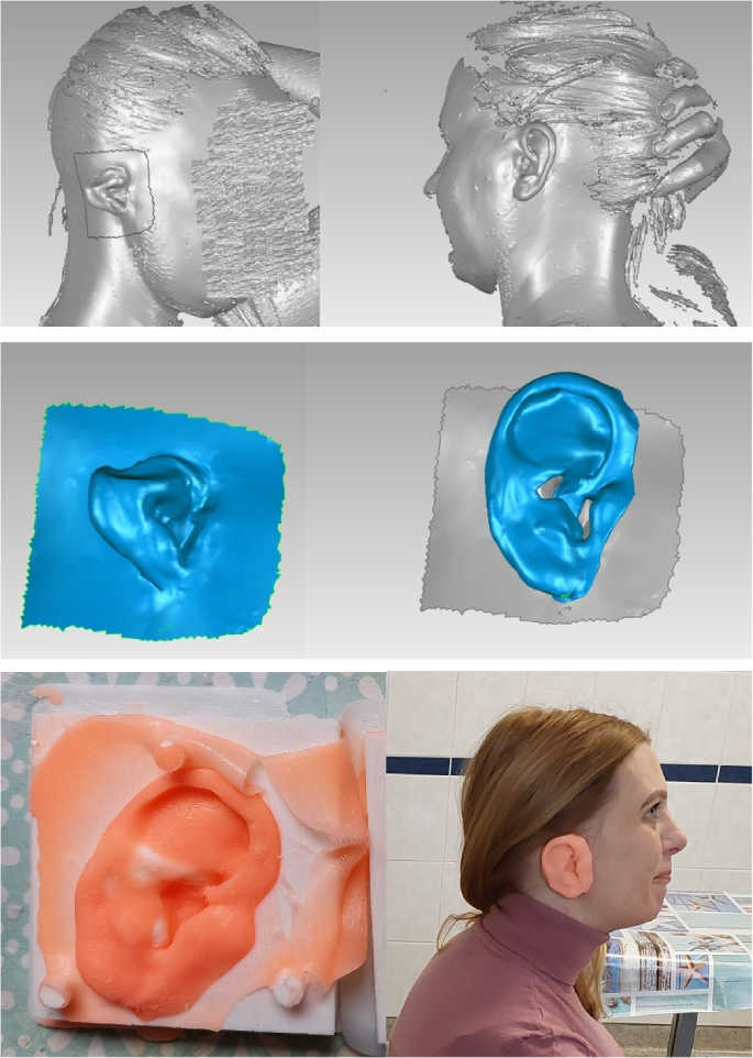 Artwork Of Prosthetic Stapes In Middle Ear Photograph by John