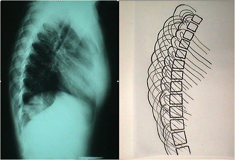 Rib index | Scoliosis and Spinal Disorders | Full Text