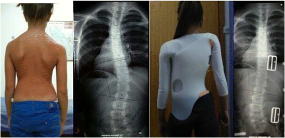 Boston Brace: First Check before X-Ray - Scoliosis and Spine Online Learning