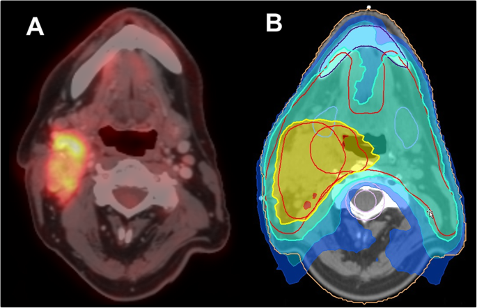 Recent advances of PET imaging in clinical radiation oncology | Radiation  Oncology | Full Text