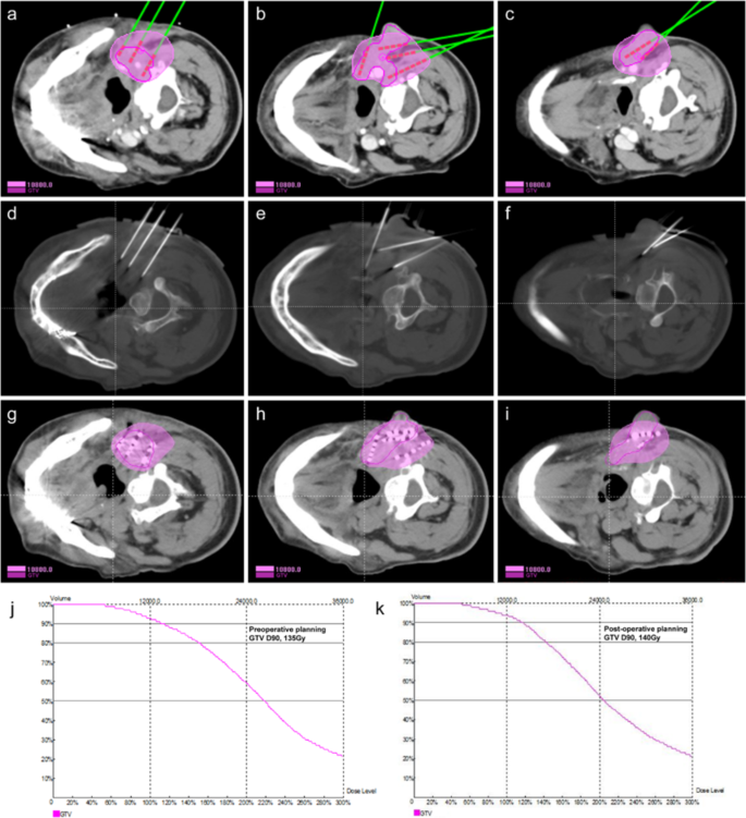 Localisation accuracy with iodine‐125 seed versus wire guidance for breast  cancer surgery - Ratnagobal - 2023 - Journal of Medical Radiation Sciences  - Wiley Online Library