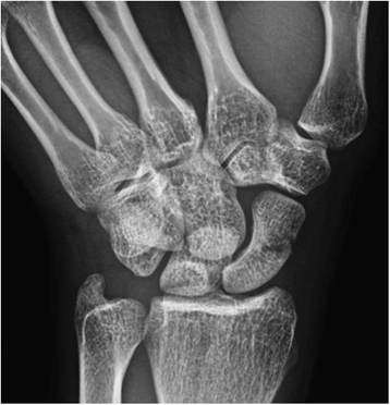 Taking a holistic approach to managing difficult stress fractures | Journal  of Orthopaedic Surgery and Research | Full Text