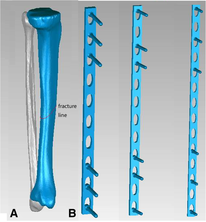 The impact of plate length, fibula integrity and plate placement on tibial  shaft fixation stability: a finite element study | Journal of Orthopaedic  Surgery and Research | Full Text