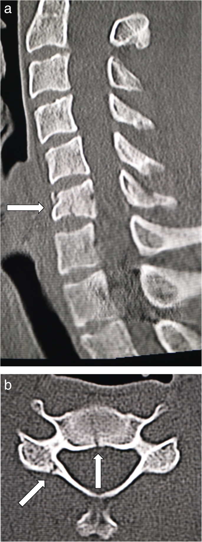 Progression of local kyphosis after conservative treatment for compressive  cervical spine fracture with spinal cord injury | Journal of Orthopaedic  Surgery and Research | Full Text