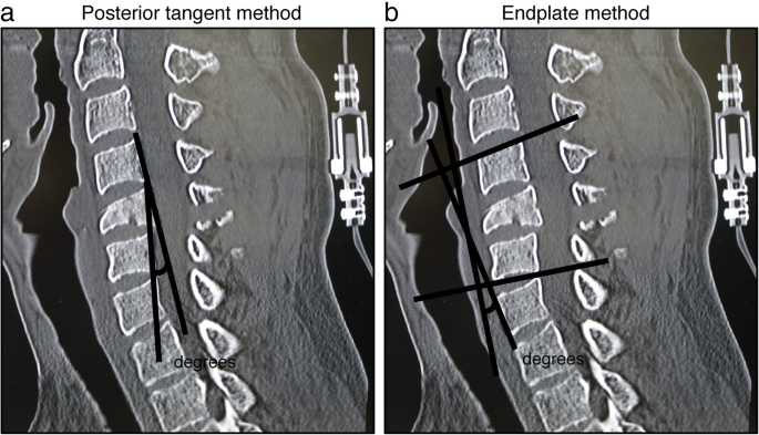 Progression of local kyphosis after conservative treatment for compressive  cervical spine fracture with spinal cord injury | Journal of Orthopaedic  Surgery and Research | Full Text