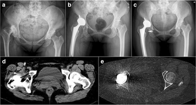 Iliopsoas Tendonitis Following Total Hip Replacement In Highly Dysplastic  Hips: A Retrospective Study | Journal Of Orthopaedic Surgery And Research |  Full Text