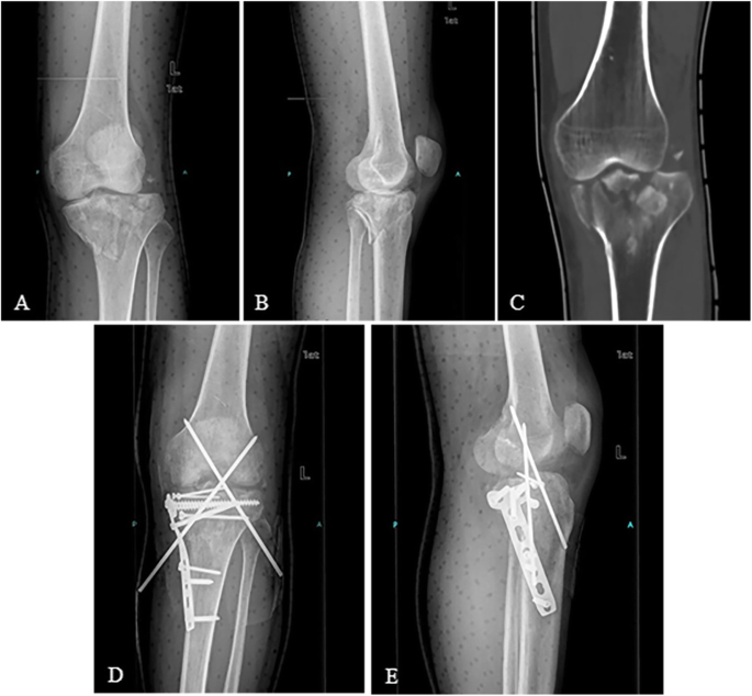 Retrospective analysis of 514 cases of tibial plateau fractures based on mo...