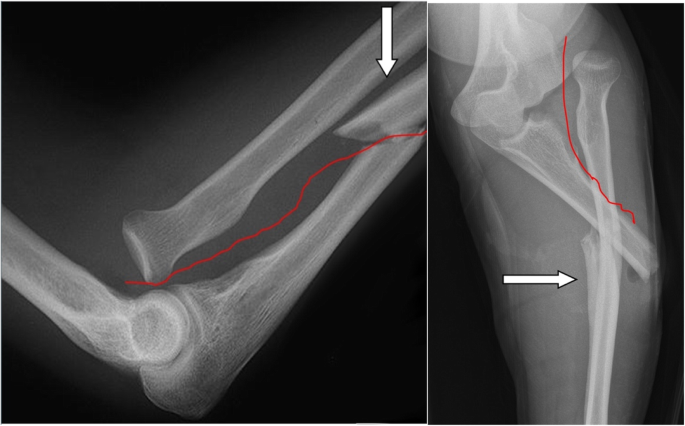 proximal radioulnar joint